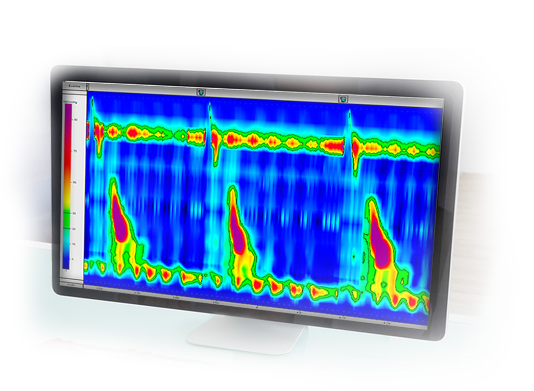 MULTIPLEX High Resolution Esophageal Manometry